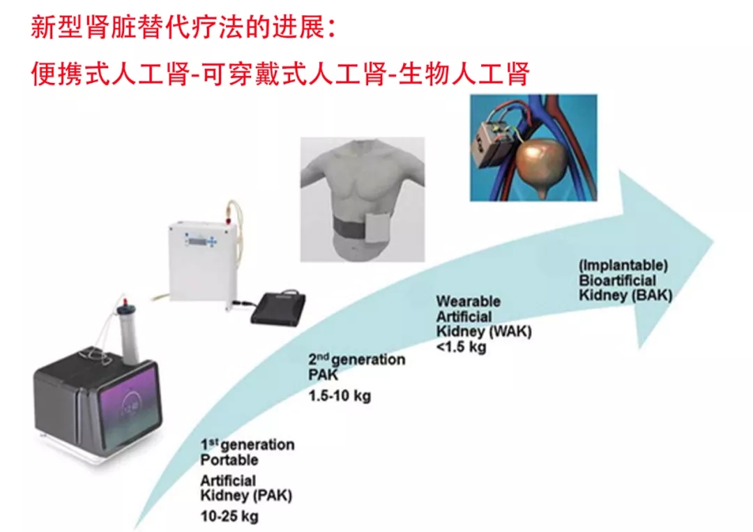 人工肾脏突破与创新引领肾病治疗新纪元