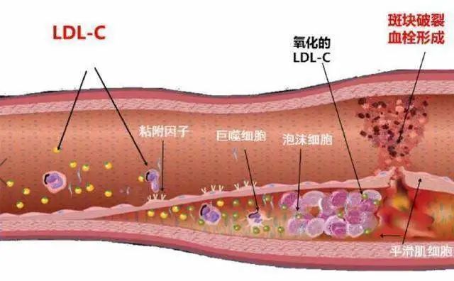 颈动脉斑块特效药最新研究及临床应用