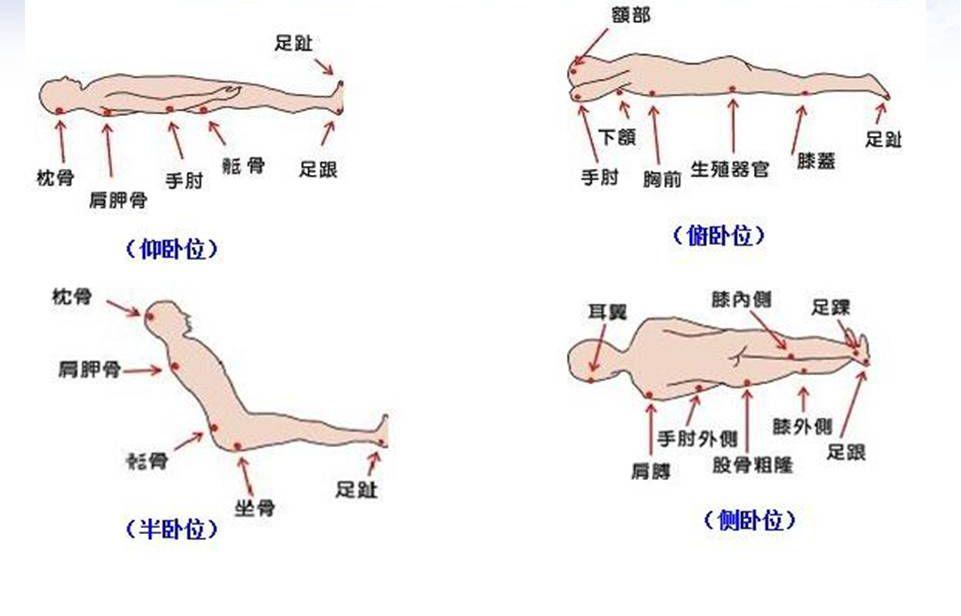 最新压疮分期研究，临床意义与进展探索