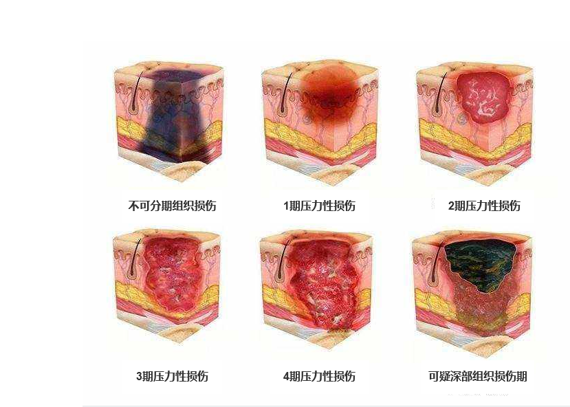 压疮最新分期及其临床意义解析